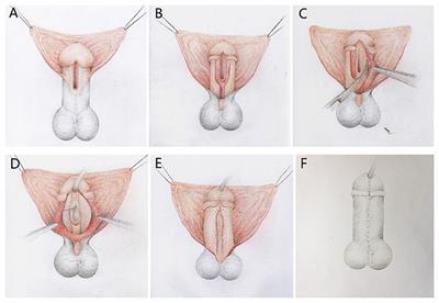 dependent de penis